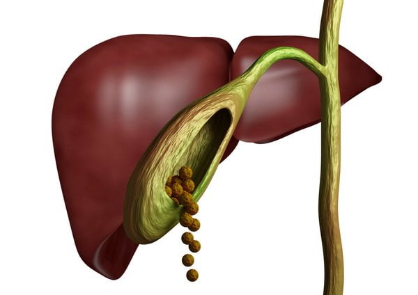 gallstone symptoms surgery Gallmet capsules
