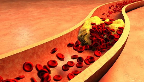 high cholesterol level Gallmet capsules