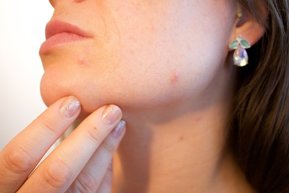 psoriasis treatment Gallmet capsules